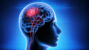 head-scan-brain-cancer-tumor.webp.webp