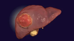 liver-cancer-tumor.webp.webp