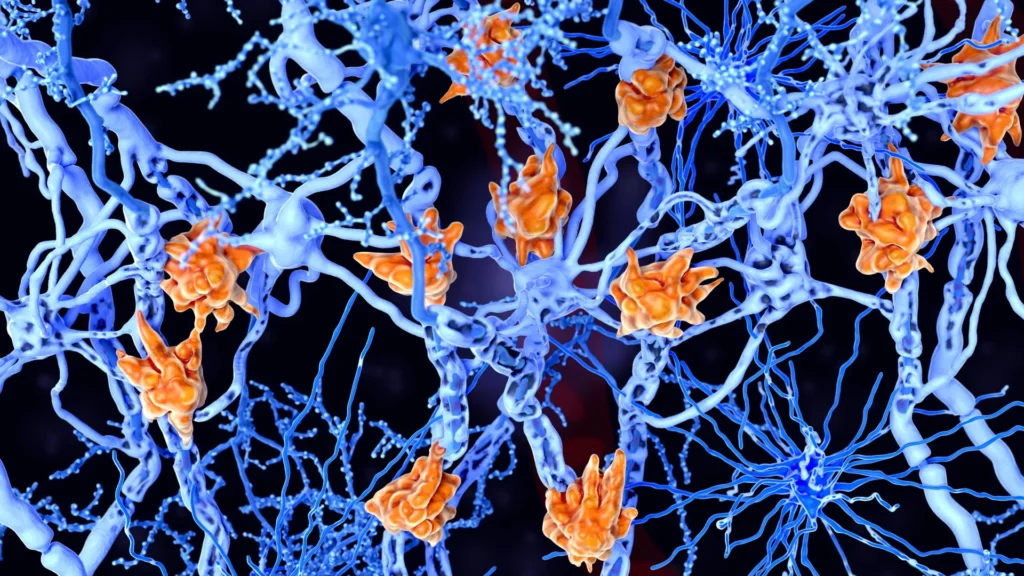 multiple-sclerosis-microglia-cells-damage-neurons.webp.webp
