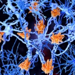 These fat-filled brain cells may be making multiple sclerosis worse