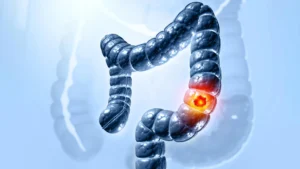 colorectal-cancer.webp.webp